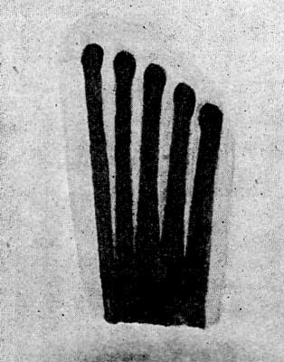 FIGURE 3.&mdash;SKETCH OF A BABY'S FOOT.